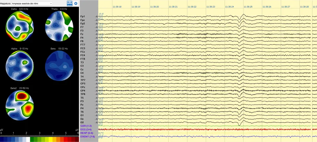 Links wird die Aktivität verschiedener Arten von Gehirnwellen in Scans dargestellt, rechts wird die Gehirnaktivität in Linien angezeigt